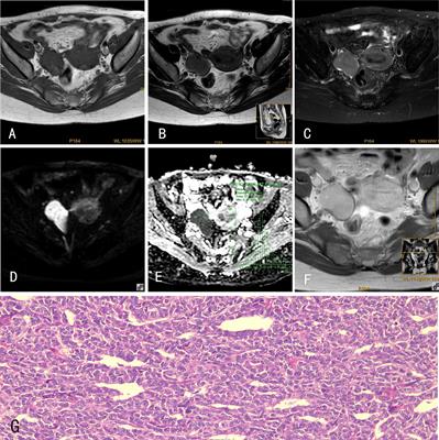 Apparent diffusion coefficient histogram analysis for differentiating solid ovarian tumors